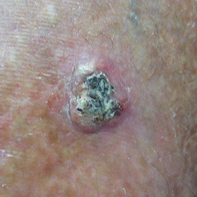 Squamous-Cell-Carcinoma
